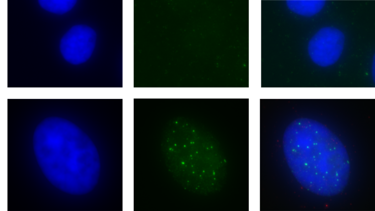 The image shows stained cells in two rose: a comparision between the top row (displaying normal cells) versus the bottom row (showing ATRX deficient bottom row) shows that there are many more trapped TOP1 proteins in the bottom row image.
